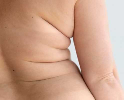 lipedema
