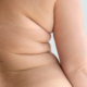 lipedema
