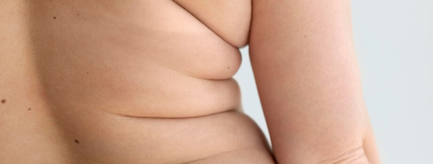 lipedema